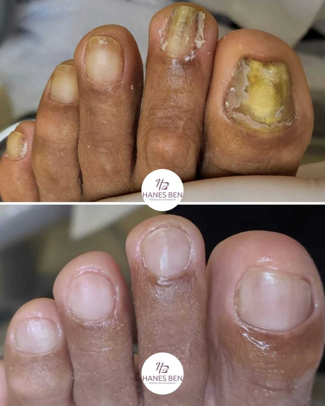 hanes-ben-podologia-avançada-micose