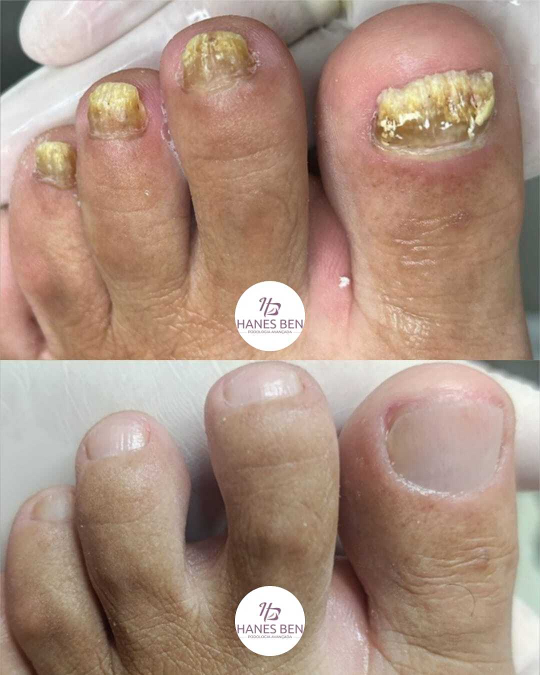 hanes-ben-podologia-avançada-micose-unhas