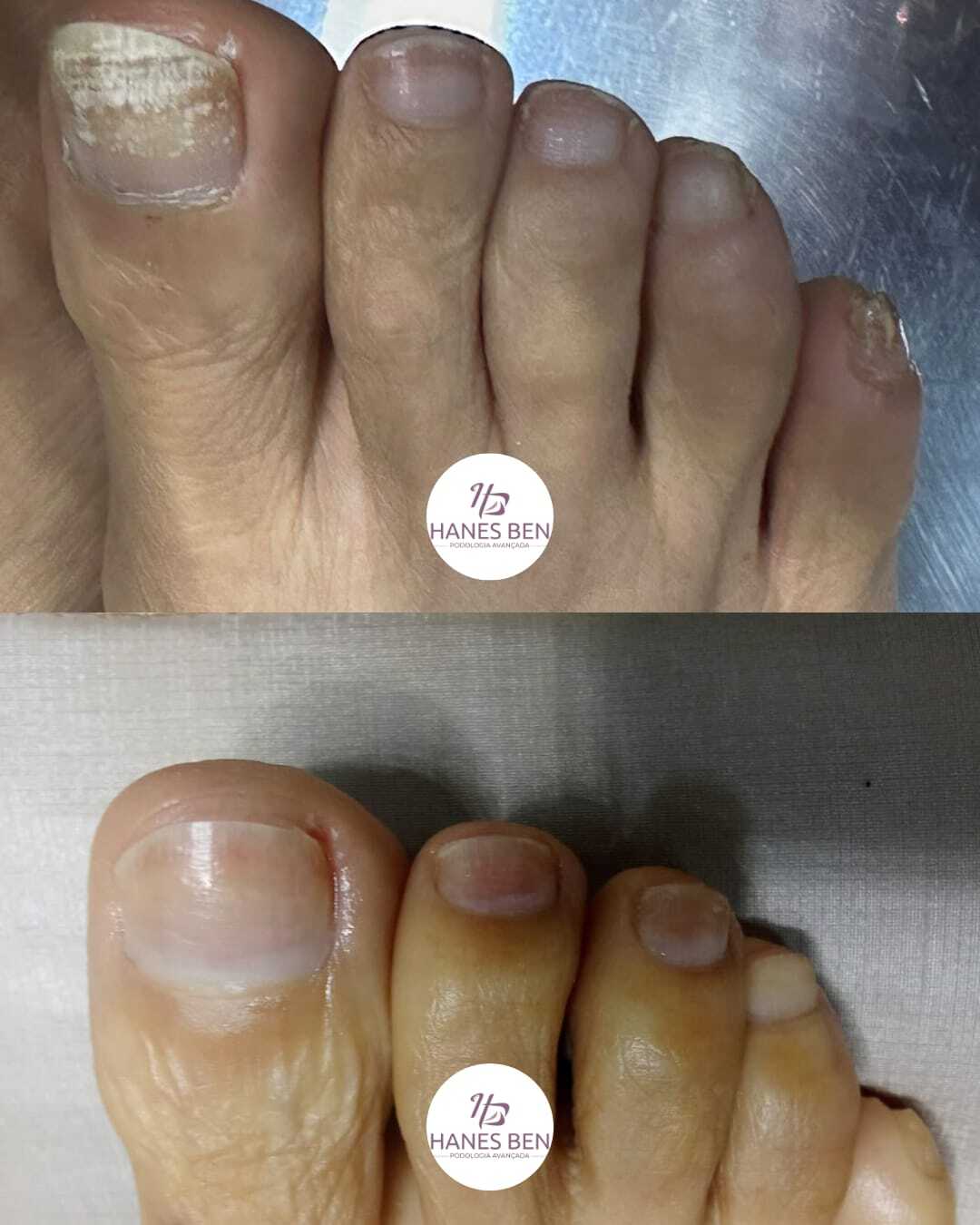 hanes-ben-podologia-avançada-micose-unhas-dos-pés