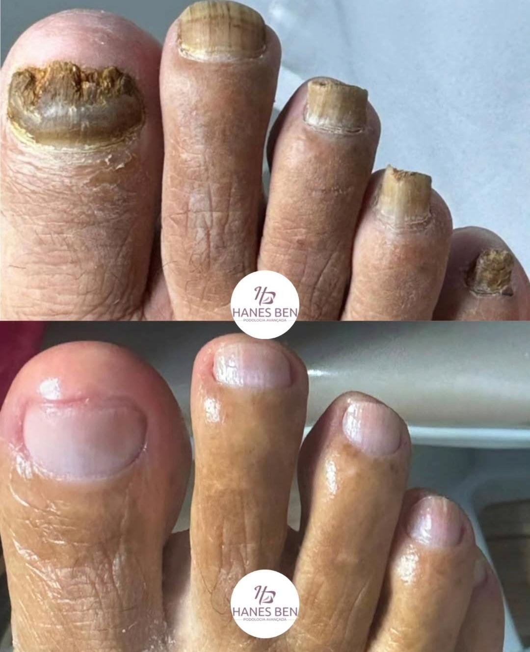 hanes-ben-podologia-micose