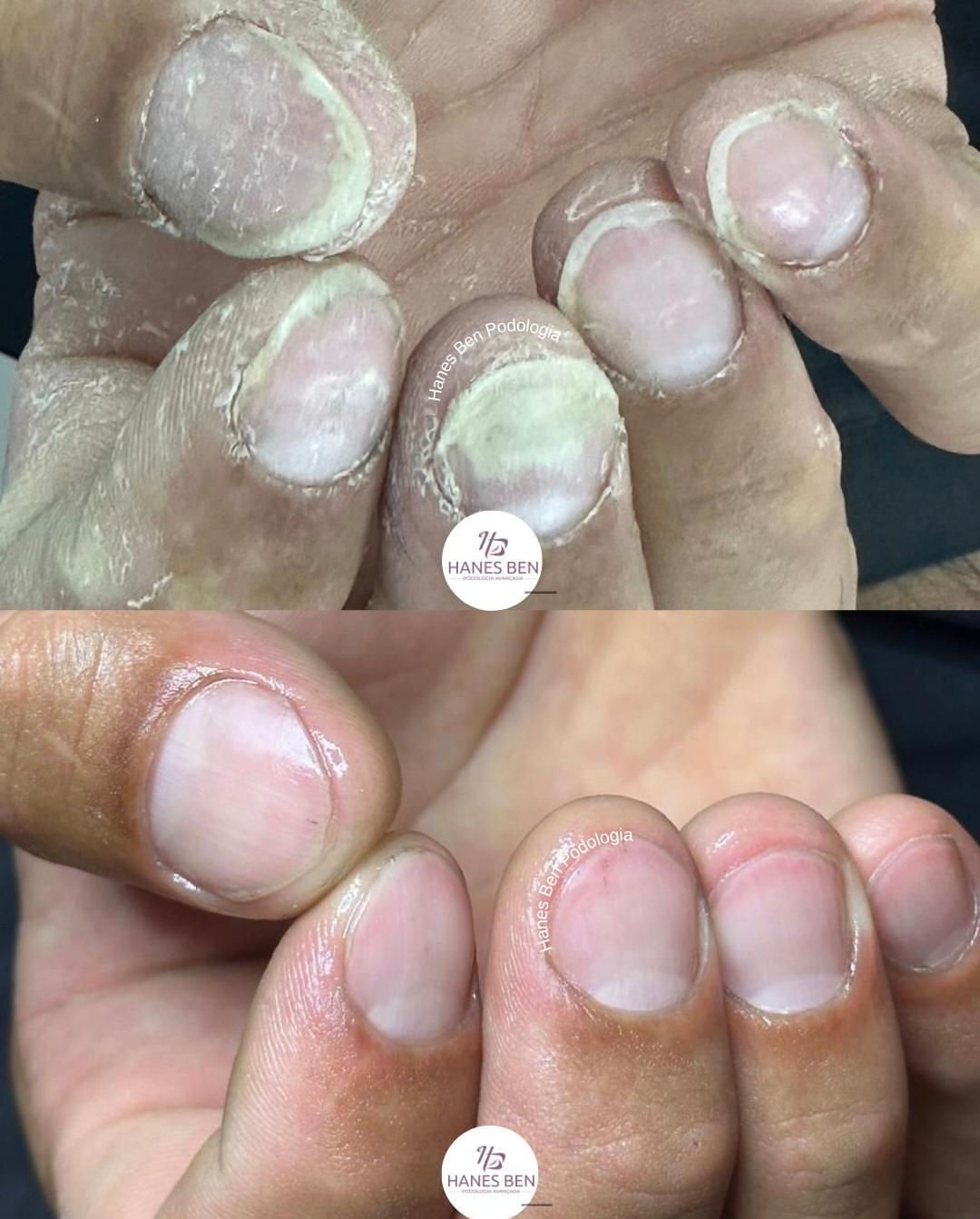 tratamento-micose-unhas-mão